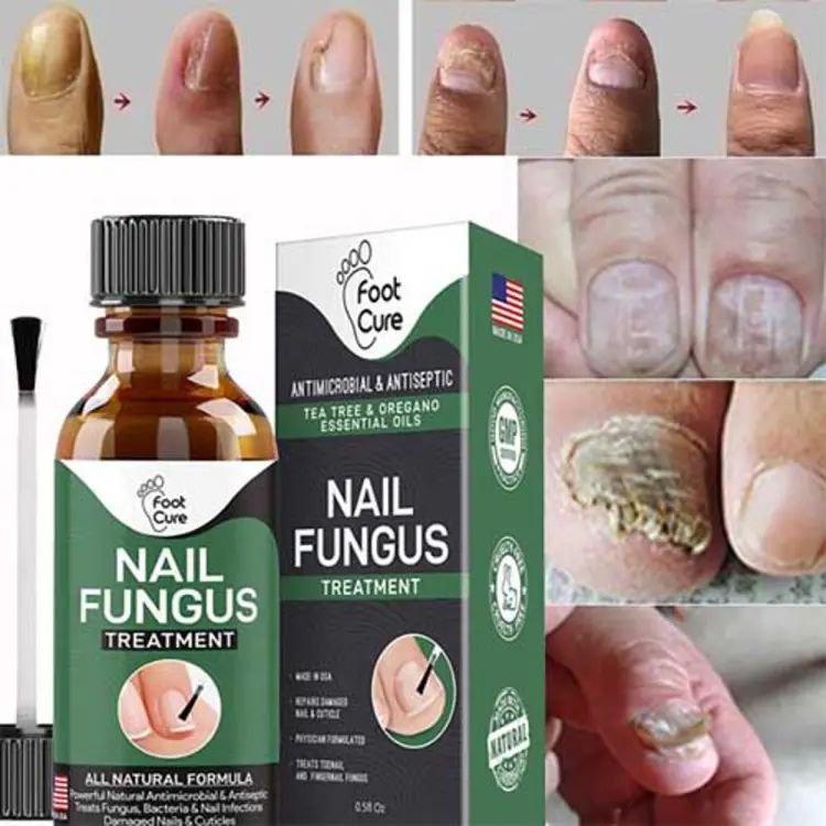 nail-fungus-treatment-stop-fungal-growth-effective-fingernail-10ml-27098-506.jpg